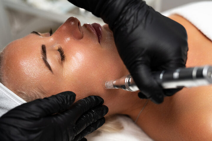 Microneedling Behandlungsfoto